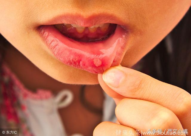口腔溃疡也是一种需要重视的疾病