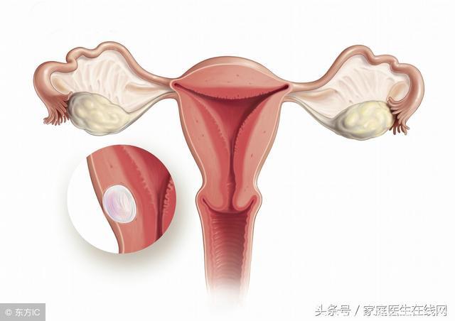 女人要预防子宫肌瘤，除了做到这3点，没有更好的方法