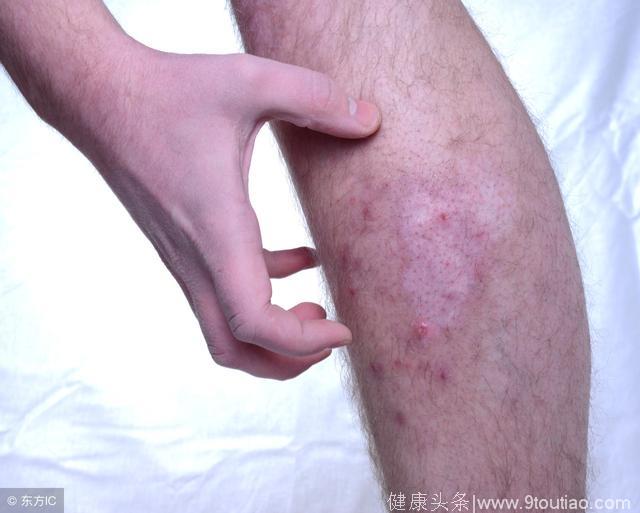 皮肤瘙痒大半年，病根是肝硬化！还有三个症状切记不要忽视了