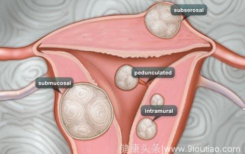 子宫肌瘤的三类高危人群 哪些方法可预防