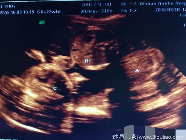 38岁广东孕妇怀上三胞胎，剖开子宫后，医生直夸赞“是个好宅院”