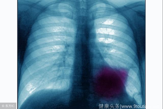 科学的检查手段让早期肺癌切勿漏网