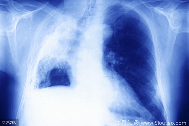 科学的检查手段让早期肺癌切勿漏网