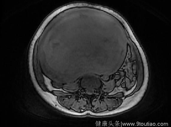 婆婆忌讳就医 子宫肌瘤长成了一个“篮球”