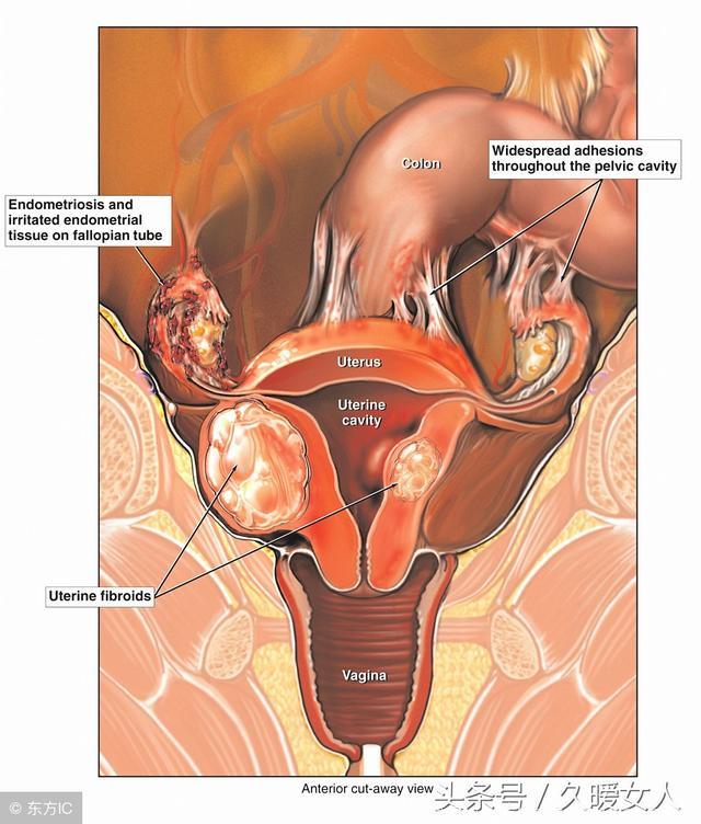 盆腔积液是怎么引起的？盆腔积液会影响怀孕吗？