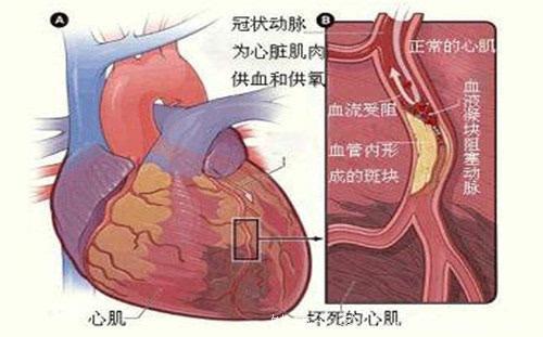 心脏搭桥是如何治疗冠心病的？心脏搭桥手术的危险性高吗？