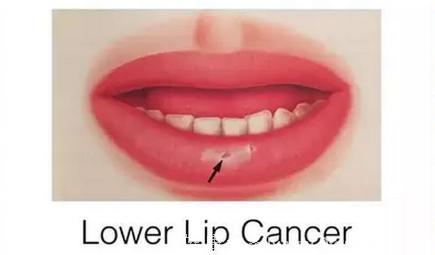 69岁大爷每天两包烟反复溃疡患唇癌 唇癌有哪些症状？
