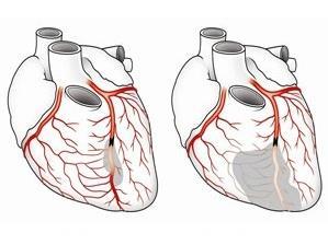冠状动脉CTA和冠状动脉造影有什么区别？