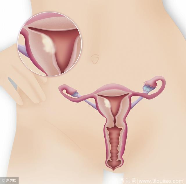 子宫内膜癌早期症状多有显示