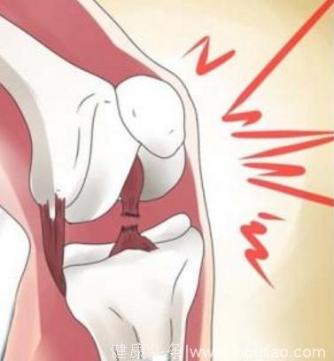 膝盖膝关节经常出现“咔咔”响，小心了，你可能是得了这种……