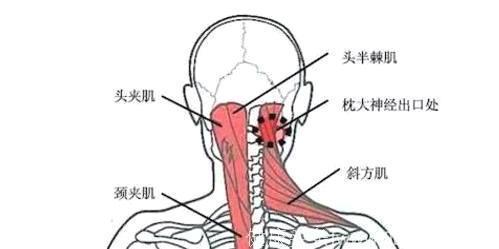 秋季颈椎治疗：学会“斜方肌锻炼”才能养出好颈椎！