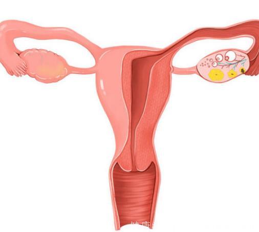 阴道出血的背后 子宫内膜癌