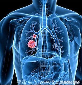 肺癌终末期的痛苦多种多样，概括起来无外痛堵热，这里有缓解方法