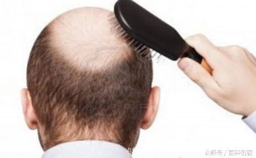 脱发的人更长寿？网友：坚持熬夜脱发，离长寿不远了！