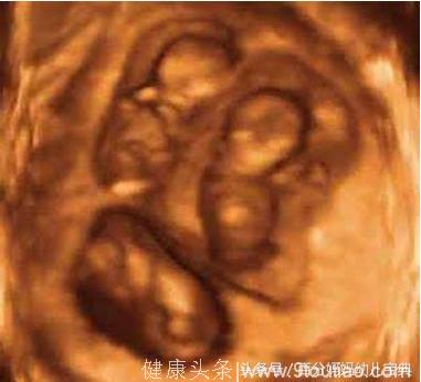 36岁广东孕妈喜怀三胞胎，剖腹产以后，医生连赞叹“好宅院”