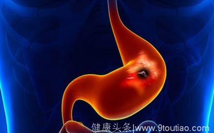 中国每年17万人死于胃癌，如果你有下面7个习惯，就要小心胃癌了