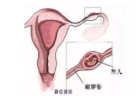 浙江37岁女子怀孕，一查子宫是空的！医生竟通过肚脐取出……