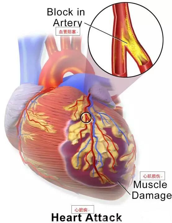 一文让您读懂什么是冠心病、心绞痛、心肌梗死