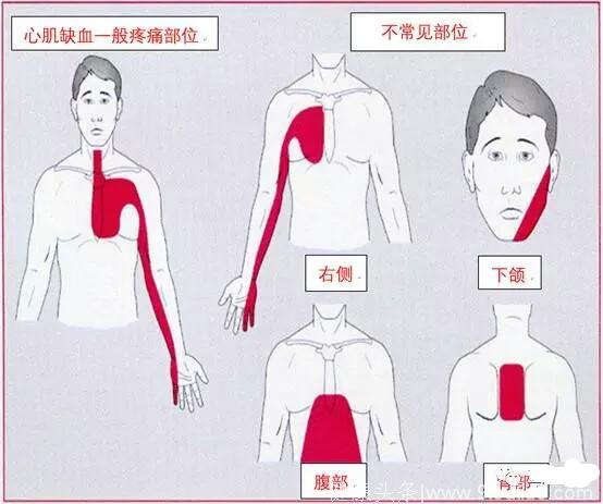 一文让您读懂什么是冠心病、心绞痛、心肌梗死