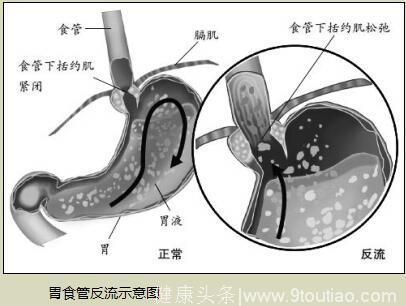 哮喘咳嗽鼻炎久治不愈?当心被误诊!