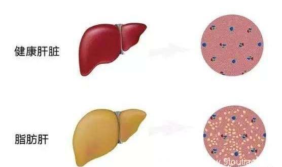 肝脏外表面包裹一层脂肪，就是脂肪肝?
