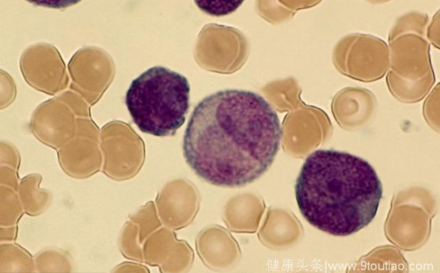 如何消除这种生长能力特旺盛的恶性细胞——白血病细胞？