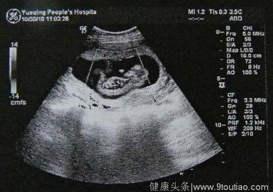 怀孕一个月b超图 让你一眼看懂b超图