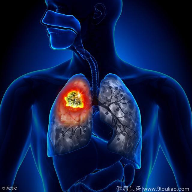 为什么肺癌转移得快 肺癌可以转移到哪些部位