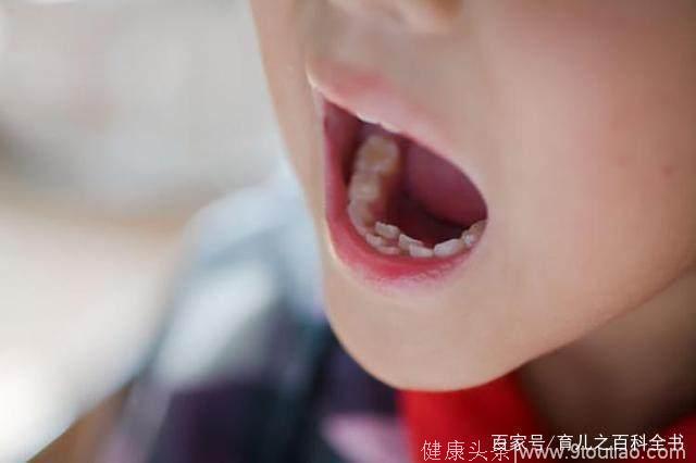 由于饮食不当，至少30%孩子都长出了双排牙，家长们别不当回事