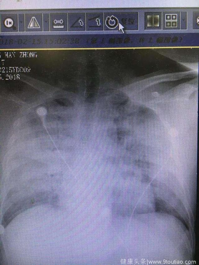 壮汉一个小感冒发展为重症肺炎，胸片显示白肺！