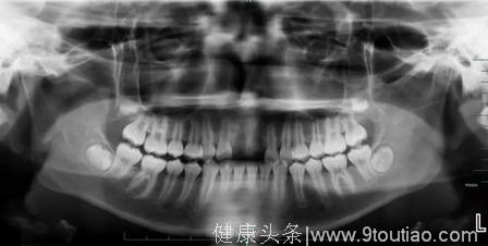 杭州13岁男孩摔了一跤后掉了2颗大门牙 治疗竟是“按回去”