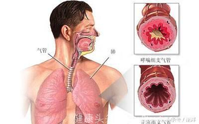 上一秒还能唱歌，下一秒就说不出话来，支气管哮喘的预防和治疗