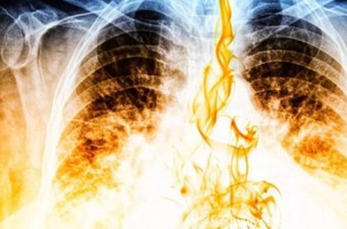 预防肺癌应注意什么？专家建议早筛早诊才能尽早发现早期肺癌