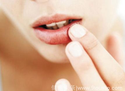 口角炎擦什么药才能好得快？口角炎不同类型应当对症下药