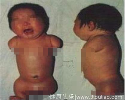 28岁孕妈孕检查出“海豹胎”，坚持生下来后，全家人痛哭流涕