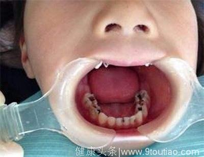 儿童看牙为什么要全麻？会对孩子有影响么？