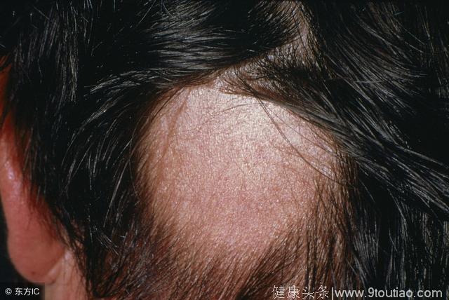 男人脱发跟这4种疾病脱不了干系