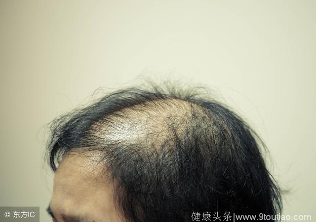 男人脱发跟这4种疾病脱不了干系