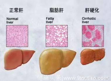 4个信号提示脂肪肝要“恶化”，需警惕肝硬化，这4种食物要戒掉！