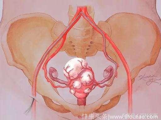 怀孕遇上子宫肌瘤,怎么破？子宫肌瘤如何与宝宝“共生”？