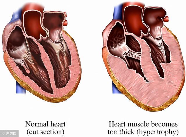 「患者说」心脏瓣膜病真有那么可怕？还必须换？有哪些病变！