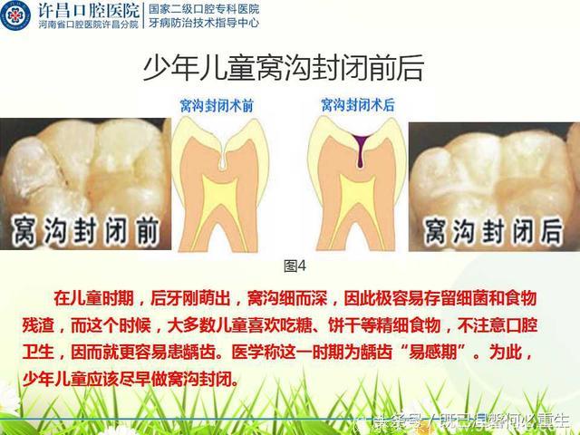 8-10岁儿童常见口腔疾病及预防