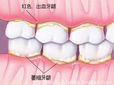 牙缝为啥这么大？口腔溃疡癌变？口腔那些事，总有你关心的