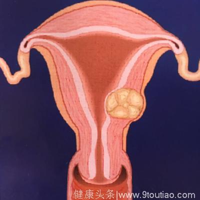 子宫肌瘤孕前必须清理吗？长了子宫肌瘤怀孕该注意啥？