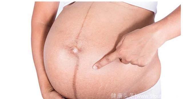孕妈肚子上有黑线就是生男孩？快来看看这条黑线是什么