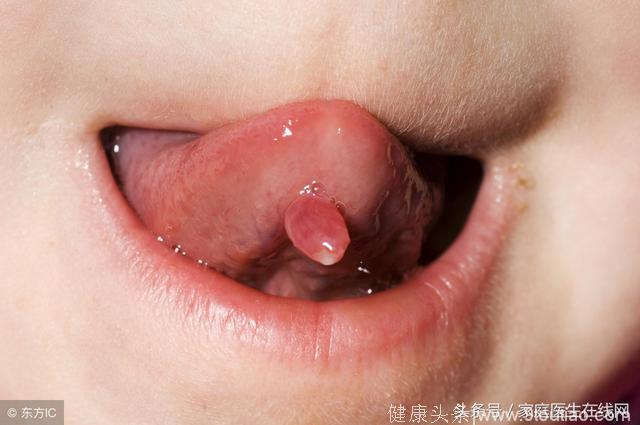 口腔溃疡也能演变成癌症？医生：注意这4点，预防舌癌发生