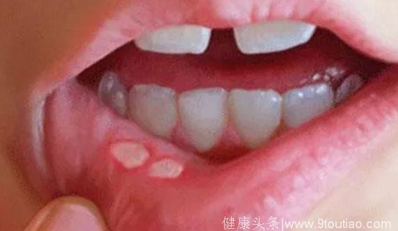 武汉婆婆口腔溃疡没在意，三周后被确诊为舌癌！医生：牙齿出现这些情况要注意！