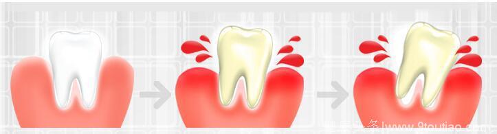 每天醒来都牙龈出血严重？你不得不注意你的口腔炎症了！