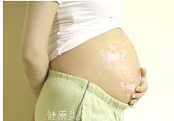 东京大学研究：春季受孕最佳。 怀孕期间怎样避免白癜风危害？