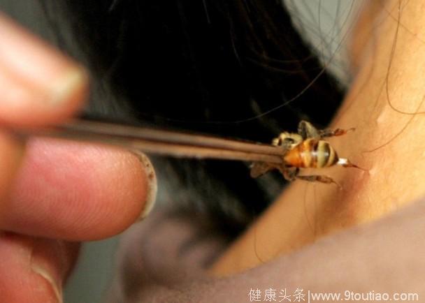 女子用活蜂针灸舒缓肌肉疼痛 意外过敏致多器官衰竭死亡